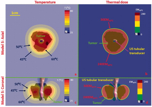 Figure 11. Temperature and thermal dose distributions for patient-specific Model 5 along the axial (a and b) and coronal planes (c and d) after 300 s sonication with an endobronchial tubular applicator (1.7 mm transducer OD × 10 mm, 360° active zone, 7 MHz, 12.5 W/cm2). The 2 cm diameter tumor volume is encompassing and adjacent to the tertiary bronchial airway, surrounding with higher inflated lung. Temperature contours of 45 °C, 50 °C, and 60 °C are shown in (a) and (c), and dose contours of 30EM43˚C and 240EM43˚C are shown in (b) and (d). US: ultrasound.