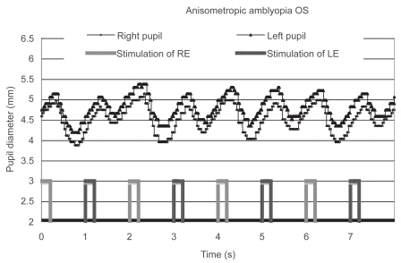 Figure 3 Pupillographic tracings of an 8-year-old girl with anisometropic amblyopia OS. The visual acuity OS was 20/30. The timing of light stimulation is shown below the pupillographic tracings. The right-eye stimulation resulted in a greater contraction than did the left-eye stimulation.