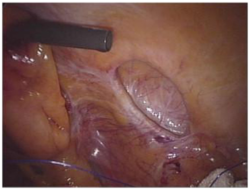 Figure 6 Spiegel’s hernia – robotic view of the fibrous ring and hernia cavity with the possibility of free 360° rotation of robotic camera.