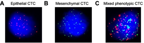 Figure 2 Identified EMT markers by RNA-in situ hybridization. (A) an epithelial CTC (red dots); (B) a mesenchymal CTC (green dots); (C) a mixed phenotypic CTC (red and green dots).Abbreviations: EMT, epithelial-to-mesenchymal transition; CTC, circulating tumor cell.