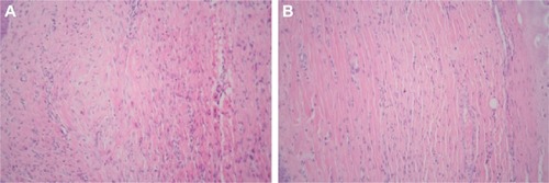 Figure 2 Comparison of control group (A) versus treatment group (B): fibroblasts, collagen, and blood vessels in scar tissue (HE staining, 200×).
