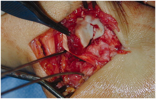 Figure 3. Intraoperative reduction of the trapezoid before screw stabilization.