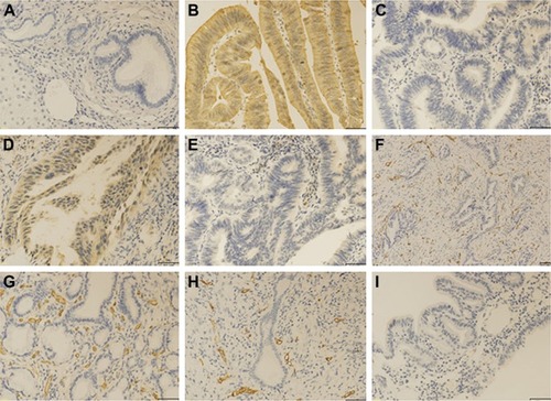 Figure 3 Immunohistochemical staining for CD155, VEGF, and CD31 in CCA tissues and adjacent nontumor tissues.