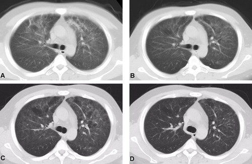 Figure 2 Representative CT images from a 28-year-old male patient that underwent deceased donor renal transplantation after 6 years of hemodialysis. The images show the change in CT features before and after treatment for PJP. (A) Signs of PJP appeared 11 months after renal transplantation. CT showed ground-glass opacities in both lungs in the first medical visit. (B) Five days after treatment, CT showed slight improvement of the pulmonary lesion. (C) Ten days after treatment, CT showed further improvement of the pulmonary lesion. (D) One month after treatment, CT showed complete absorption of the pulmonary lesion.