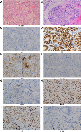 Figure 2 ((A) ×200) Hematoxylin and eosin staining showing tumor cell nests infiltrating into the salivary gland tissues. Malignant cells show prominent nucleoli, nuclear atypia, and foamy cytoplasm. ((B) ×400) Perineural invasion was present in the tumor tissue. ((C) ×400) Immunohistochemical examination showed: negative staining for androgen receptor; ((D) ×400) positive staining for CK7; ((E) ×400) positive staining for epithelial membrane antigen (EMA) in focal areas; ((F) ×400) negative staining for GCDFP; ((G) ×400) KI-67 index of approximately 15%; ((H) ×400) positive staining for MLH1; ((I) ×400) positive staining for P63; ((J) ×400) negative staining for S-100.