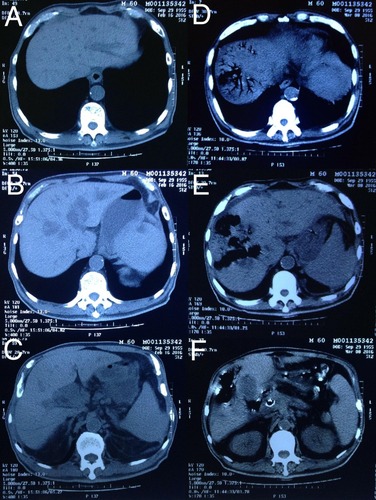 Figure 1 (A)–(C) Abdominal computed tomography (CT) before stenting revealed intrahepatic duct dilation due to obstruction of pancreatic mass. (D)–(F) Emergency CT showed gas-containing lesions in the liver, containing liver parenchymal moth-eaten destruct and pneumatized bile duct without obvious inflammation around. (F) The stent was right in the common bile duct without obstruction.