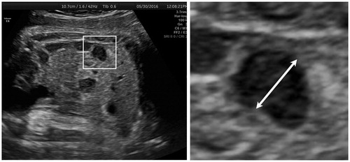 Figure 1. Identification of the largest loop of the colon (coronal plane) at 35 weeks of gestation. Measurement of the short axis of the bowel lumen (inner to inner bowel wall).