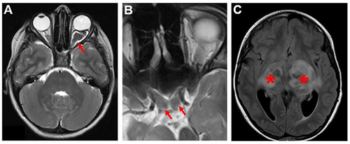 Figure 1 NF1-OPGs in children. (A) A pre-chiasmatic OPG (red arrow) involving the left optic nerve. The optic nerve is enlarged and tortuous compared to the normal optic nerve on the right. (B) An OPG involving the optic chiasm. Red arrows point to the enlarged chiasm. (C) An OPG involving the bilateral optic radiations (red asterisks). The images are axial T2-weighted MRI scans.