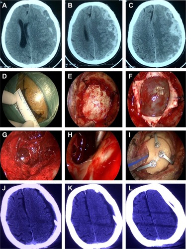 Figure 2 Neuroendoscopic surgery for subacute subdural hematoma.