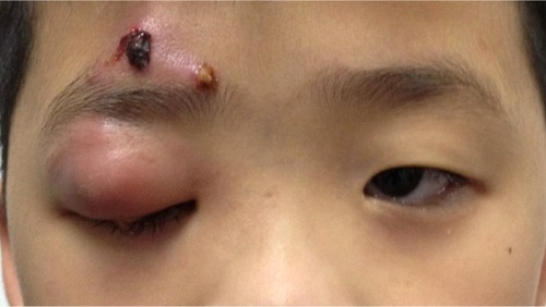 Figure 1 Right upper eyelid swelling causing complete ptosis with crusted pus at the surgical wound site.