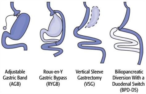 Figure 3 Commonly used bariatric surgery procedures.