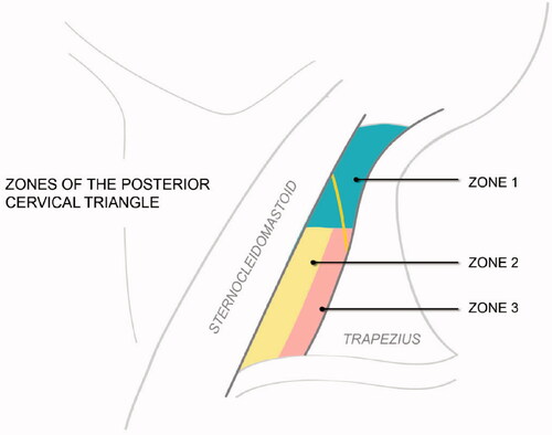 Figure 1. Three zones of the posterior cervical triangle.
