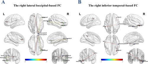 Figure 4. Significant alterations of functional connectivity (FC) in adolescents with borderline personality disorder (BPD) compared with healthy controls (HCs), using the right lateral occipital and right inferior temporal regions as seed points. (A) Increased FC of the right lateral occipital gyrus with the right inferior orbitofrontal gyrus, right inferior frontal gyrus, and right anterior cingulate gyrus. (B) Increased FC of the right inferior temporal gyrus with the right inferior orbitofrontal gyrus and left inferior temporal gyrus. Voxel p < .001, cluster p < .05, family-wise error (FWE) corrected. The colour bar indicates the T score.