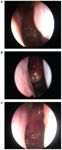 Figure 1 Thirty-degree rigid endoscopic appearance of nasopharyngeal bursitis. A) Crust type. Note the characteristic midline anatomic site with cicatricial streaks around the bursa. B) Cystic type. Photos are representative of three patients of each type showing very similar appearance. C) One-year postoperative endoscopic view of the crust type.