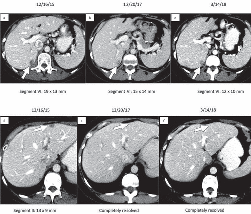 Image 1. Contrast-enhanced CT images of the upper abdomen prior to initiating nivolumab (a, d) demonstrate low attenuation metastases within hepatic segments VI and II (arrows). Follow-up CT 2 years later (b, e) demonstrates that the metastasis in segment VI has decreased while the metastasis in segment II has completely resolved (arrows). Similarly, follow-up CT on 3/14/2018 (c, f) after cycle 64 of nivolumab demonstrates that the segment VI metastasis has again decreased and the segment II metastasis is still resolved (arrows)