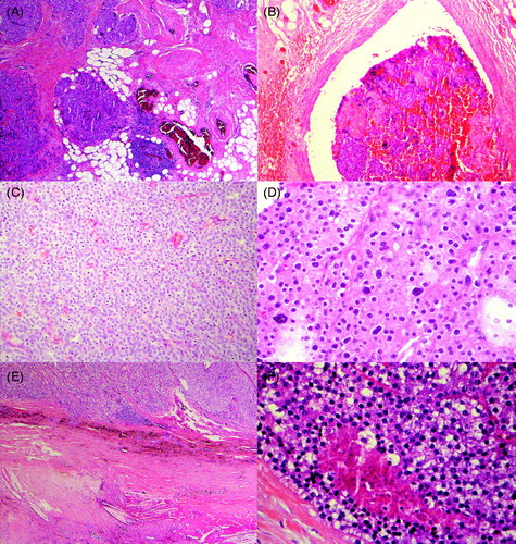 Figure 2. Diagnostic (A–B) and typical (C–F) findings in parathyroid carcinoma. A: Infiltrative growth to adipose tissue, B: Vascular invasion, C: Diffuse growth pattern, and 100% chief cells, D: Nuclear atypia, E: Fibrous bands and hemosiderin, F: Necrosis.