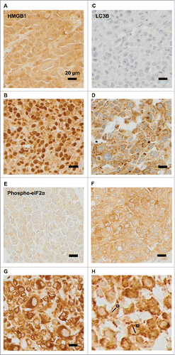 Figure 2. Representative immunohistochemical staining patterns. (A–B) Representative images of melanomas that are heterogeneous with respect to the presence of HMGB1 within nuclei (absence: A, presence: B). (C–D) Representative images of melanomas differing in the percentage of cells positive for cytoplasmic LC3B puncta (absence: C, presence D). (E–H) Representative images of phospho-eIF2α-staining in melanoma metastases: (E): mild, (F): moderate, and (G): intense, (H): measures of nuclear diameters (bars), and phospho-eIF2α-staining intensity (squares).