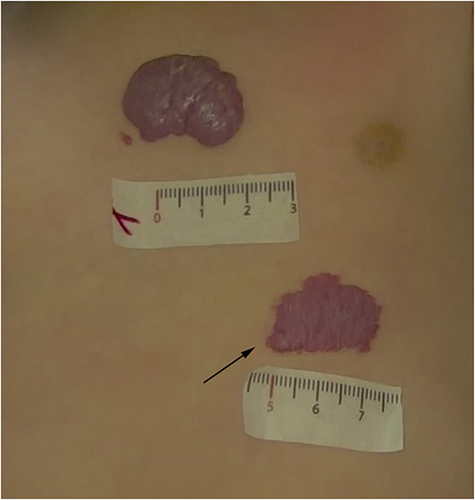 Figure 1 Two irregular erythematous plaques hemangioma on the left anterior chest and on the left upper abdomen. The black arrow indicates the observation area for the dermoscope.