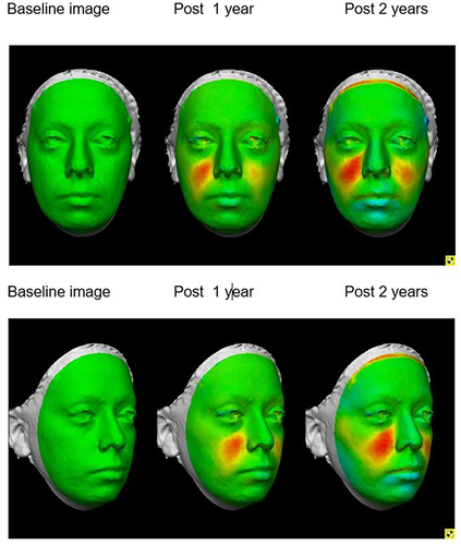 Figure 1 Frontal and profile colour distance maps of 38-year old patient injected with a total volume of 1.0cc of PCL- filler both malar areas.