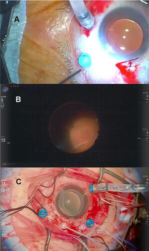 Figure 3 Intraoperative images. (A) The first operation for the left eye with conventional bright light under retrobulbar anesthesia (RBA). The patient moved his head as he felt intolerable discomfort from the bright light of the light pipe. Although we reduced the luminance level to 60%, he refused vitrectomy. (B) The second operation for the right eye, the fourth surgery in total, using the heads-up surgery system with minimal illumination under RBA. Although the luminance of the light from the light pipe was as low as a quarter of that used in the previous operation (15%), the intraoperative visibility was sufficient to perform vitrectomy. The patient tolerated this light level and did not complain of photophobia. (C) The third operation for the right eye, the fifth operation in total, with inadvertent bright illumination under RBA. After encircling and vitrectomy (approximately 85 min), we inadvertently set the brightness level of the twin light chandelier to 100%. The luminance was the same as the 60% from the light pipe, which was high enough to evoke his photophobia. However, he did not feel photophobia, presumably because he had had enough time for light adaptation.