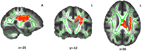 Figure 2 Fractional anisotropy differences between the Long and Reference sleep groups. The red-yellow color indicates the white matter clusters that showed lower fractional anisotropy values (α < 0.05, threshold-free cluster enhancement and family-wise error correction) in the Long sleep group compared with the Reference sleep group (at the indicated coordinates). The mean skeleton of fractional anisotropy is shown in green. The white matter tracts include the superior Corona radiata and the body of the corpus callosum. The coordinates are presented in Montreal Neurological Institute (MNI) template space.