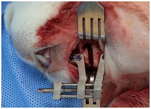 Figure 3. The custom-made titanium distractor and osteotomy line is posterior to the mental foramen. Distractor was positioned parallel to the lower border of the mandible.