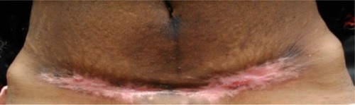 Figure 3 Healing of the cesarean wound by secondary intention (day 47).