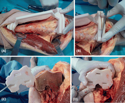Figure 4. (A) After surgical exposure of the distal femur via a medial subvastus approach, the patient-specific CAD/CAM surgical jig was positioned at the planned resection sites. (B) The bone resection was performed with an oscillating saw through the cutting slits of the surgical template. (C) A junctional plate that matched the dimensions of the resected end during virtual simulation of the distal femoral osteotomy was compared with the distal femoral resection actually achieved. (D) The dimensional difference between the planned resection (represented by the junctional plate) and the achieved resection was <1 mm, and therefore validated the feasibility and accuracy of the technique.