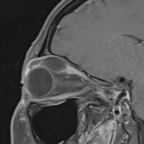 Figure 3 T1-weighted MRI sagittal view with fat suppression demonstrates well circumscribed mass, which decreases on fat suppression, in the superior rectus belly and tendon.