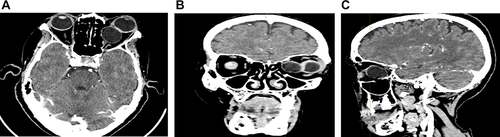 Figure 1 Computerized tomography (CT) of the brain and orbit with (A) Axial view, (B) Coronal view, and (C) Sagittal view respectively.