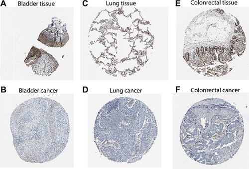 Figure 3 Protein levels of GIMAP7 in human tumours and normal tissues from the Human Protein Atlas database. (A, C, E) Normal bladder, lung and colorectum; (B, D, F) bladder cancer, lung cancer and colorectal cancer, respectively.