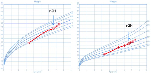 Figure 1. Growth condition before and after rGH therapy in patient-3. Source: Child Growth Standards (0–5 years), 2006, World Health Organization. Growth Reference (5–19 years), 2007, World Health Organization.