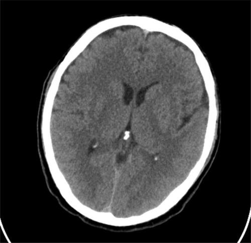 Figure 1. Control CT of the brain. No pathological changes in the parenchyma. Presence of anatomic variation (smaller left sinus transverses).