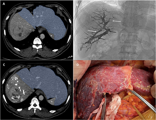 Figure 1 A 60-year-old male patient with single mass hepatocellular carcinoma of 6 cm in the right lobe and cirrhosis (Child–Pugh score = 5 points). (A) Axial computed tomography (CT) scan at the time of diagnosis; FLR volume was 457 mL, %FLR = 34.6%; *Spleen. (B) A single shot at the end of liver venous deprivation (LVD) showing embolized right portal vessels with glue (black arrows), Amplatzer vascular plugs and glue positioned on the right and hepatic vein (white arrows). After LVD, the patient presented an acute grade A liver failure (according to the International Study Group of Liver Surgery definitions) then recovered after seven days. (C) Axial CT scan at three weeks after LVD showing changes in FLR volume (655 mL) and %FLR (49.2%); *Spleen. (D) Intraoperative image showing good FLR regeneration. The patient then underwent right hepatectomy at week 5 after LVD without postoperative complications.