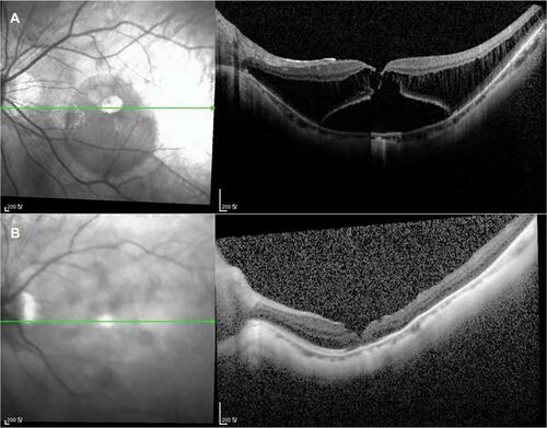 Figure 6 Pre- and postoperative OCT image of a 55-year-old woman (case 7). (A) Preoperative OCT shows foveal detachment and retinoschisis with MH. (B) 11 months after the surgery, MH closure was achieved with decreased bulging of the posterior scleral wall was seen on postoperative OCT.