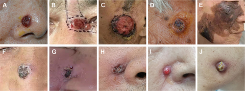 Figure 1 Clinical characteristics of rhinofacial ulcers. (A and B) Basal-cell carcinoma. (C) Squamous-cell carcinoma. (D) Keratoacanthoma-like squamous-cell carcinoma. (E) Melanoma. (F) Gangrenous pyoderma caused by sporotrichosis. (G–J) Odontogenic fistulas.