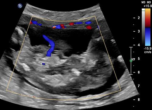 Figure 2 Color Doppler image of an acardiac twin at 14 weeks showing reverse perfusion through the umbilical cord.