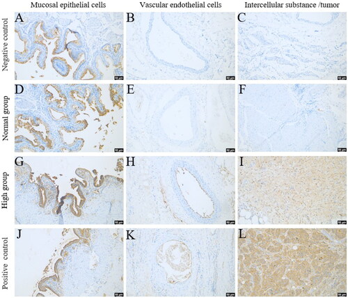 Figure 4. Expression of CA19-9 in different gallbladder regions in the high group. CA19-9 expression of mucosal epithelial cells, vascular endothelial cells, and intercellular substances or tumors in the negative control group(A ∼ C), normal group(D ∼ F), high group(G ∼ I), and positive control(J ∼ L). Scale bars = 50 μm.