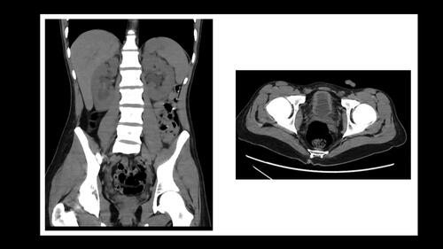Figure 2. Abdomen CT (coronal view) showing bilateral hydronephrosis and irregular thickening of bladder walls (transversal view).