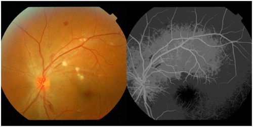 Figure 2 Cotton wool exudate and retinal hemorrhage after 12 weeks of treatment.