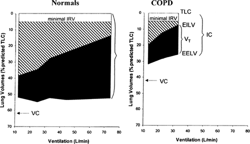 Figure 9 Dynamic hyperinflation in COPD. Source: (Citation[175]), Fig. 3, p. 774. Changes in operational lung volumes are shown as ventilation increases with exercise in patients with COPD and in normal subjects. “Restrictive” constraints on tidal volume (VT, solid area) expansion during exercise are significantly greater in the COPD group from both below (reduced IC) and above (minimal IRV, open area).