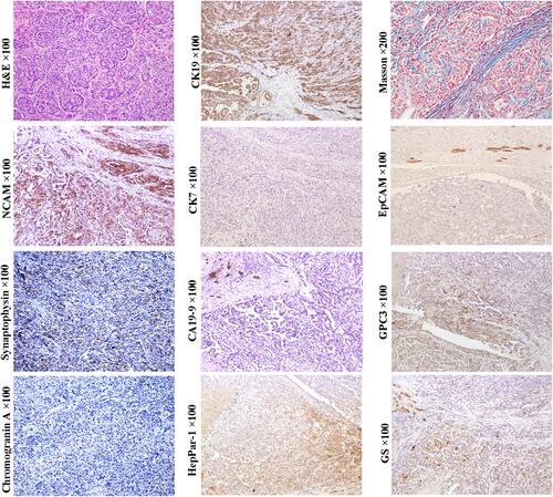 Figure 5 Example case of a CK19+/GPC3+ HCC originated from the early HCP. A 51-year-old male patient with 4.5 cm sized tumor in the right lobe of the liver. The patient has chronic hepatitis B infection. His preoperative serum AFP was 32.54 ng/mL. Extrahepatic metastasis was found at 13 months after liver transplantation. In CK19+/GPC3+ HCCs, the histology of tumor trabeculae or nests surrounded by fibrous stroma is very common. If tumors are composed of a large proportion of fibrous stroma, they may be classified as SHCC. In this case, tumor cells can express CK19 and GPC3, glutamine synthetase (GS) and HepPar1. They also express neuroendocrine marks, NCAM and synaptophysin (weak). Unlike the typical combined HCC-ICC, no ICC component was present in this subtype of HCC, and cholangiocarcinoma CA19-9 was negative.