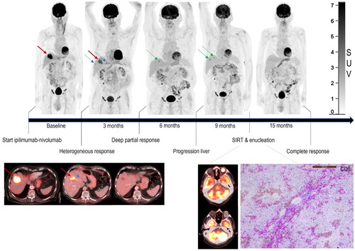 Figure 2. Response patterns to immune checkpoint inhibitors. Combination therapy with ipilimumab and nivolumab resulted in a complete remission of extrahepatic nodal and peritoneal metastases on 18F-FDG PET-CT. Response in the liver was heterogeneous, with regression of some liver metastases while others progressed. Similarly, intra-ocular tumor infiltrating CD8-positive T-cells were not able to induce a response in the eye. Nevertheless, neoadjuvant immune checkpoint inhibitor treatment allowed some patients to proceed with local therapy for refractory disease, which resulted in prolonged progression-free survival and possibly cure.