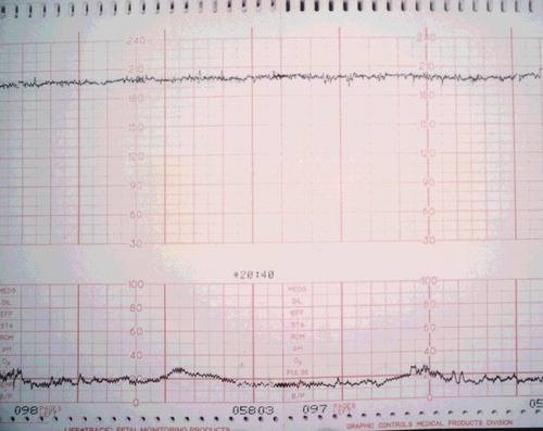 Figure 2. Fetal external monitors showing tachycardia with minimal variability and uterine contractions 2 hr and 10 min post ingestion.