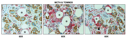 Figure 8 Lymph node-associated adipocytes and inflammatory cells are glycolytic. Paraffin-embedded sections of human breast cancer-positive lymph nodes were immunostained with antibodies directed against MCT4 (red color) and TOMM20 (brown color). Slides were then counterstained with hematoxylin (blue color). Note that lymph-node associated adipocytes (asterisks) and inflammatory cells (red arrowhead) are MCT4(+) and TOMM20(-), consistent with a glycolytic phenotype. In contrast, TOMM20 is strongly associated with the metastatic breast cancer cells. Rarely, MCT4(+) and TOMM20(-) epithelial cancer cells were also observed (black arrowhead). Original magnification, 60x.