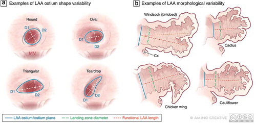 Figure 1. Examples of variability in LAA anatomy that may present challenges to imaging and device sizing and selection. (a) Various shapes of the LAA ostium have been described including round, oval, triangular, and teardrop however the association between LAA ostial shape and successful closure is not well established. (b) Morphologic variation in the body of the LAA are well-recognized including the so-called windsock, cactus, chicken wing, and cauliflower variants as well as the presence of more than one LAA lobe which may impact the success of endovascular device-based closure. Abbreviations: D1, D2 maximum diameters in 2 dimensions; MV, mitral valve; Cx, circumflex artery