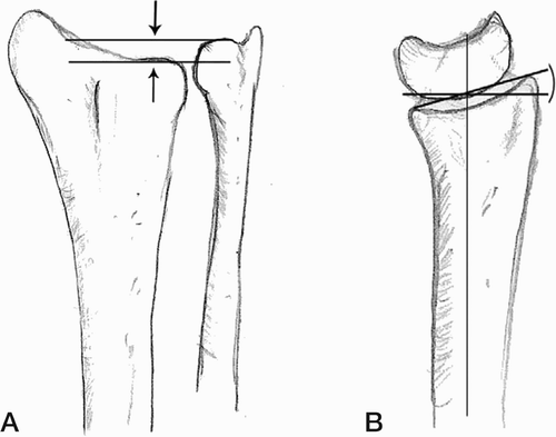 Figure 2. Drawing showing the cut‐off limits for radiographic malposition qualifying for surgery. A. Ulna plus: indication for operation is a distance of > 2 mm between the lines (normal value from -4 mm to +2 mm). B. Dorsal angulation: indication for operation is > 10° of dorsal tilt (normal value 10° (0-22) volar tilt as shown).
