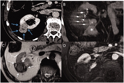 Figure 1. (A) Axial contrast-enhanced computed tomography (CT) images. Exophytic T1b renal tumor on middle third of the right native kidney (blue arrows). (B) Coronal computed tomography images during the ablation, using 5 cryoprobes, after hydro-displacement (white star). (C) Axial T2 at 1-month follow-up shows the ablation zone (white arrows). (D) Axial T1FS after injection shows no evidence of tumoral residue.
