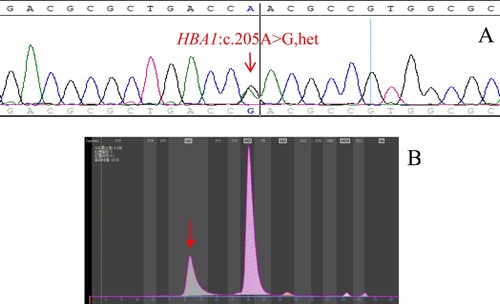 Figure 3. (A): The hemoglobin variants Hb Ube-2 identified by Sanger sequencing. The arrow shows the mutation of the HBA1 gene (B): Hb Ube-2 eluted in Z12 on the Capillarys 2 CE analyzer. The arrow shows the abnormal peak.