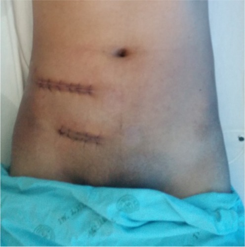 Figure 3 Surgical incisions.